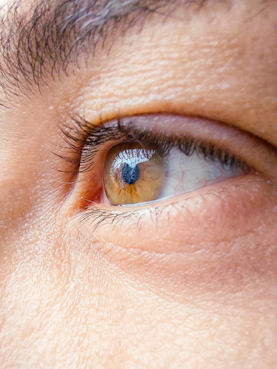 Laser eye surgery